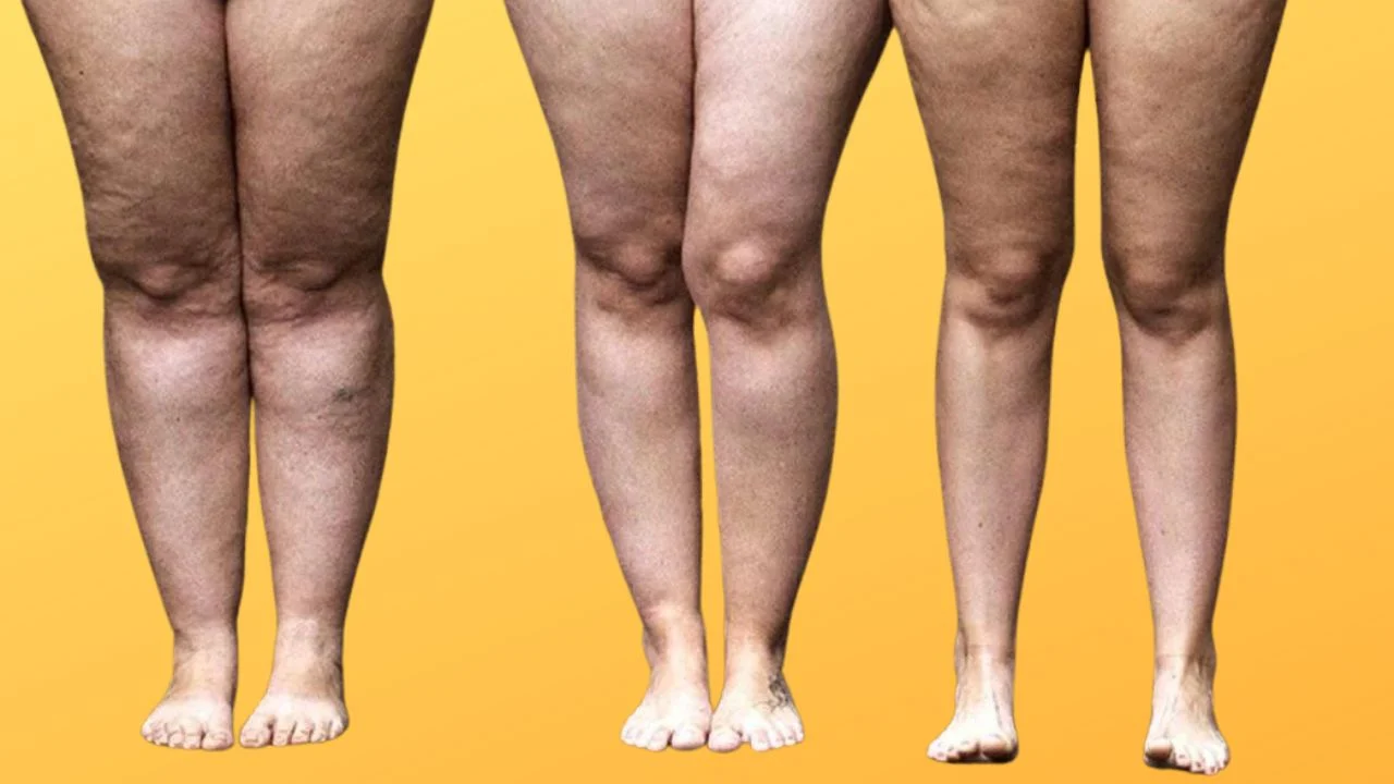 Lipedema